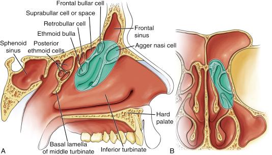 Fig. 9.4, Schematic drawings in sagittal (A) and coronal (B) views showing the structures removed in a Draf IIb dissection. The Draf IIb procedure includes the dissection of the Draf IIa procedure with the addition of the ipsilateral middle turbinate attachment to the floor of the frontal sinus; it, therefore, removes all the ipsilateral frontal sinus floor from septum to orbital wall.