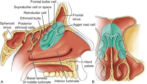 Fig. 9.5, Schematic drawings in sagittal (A) and coronal (B) views showing the structures removed in a median frontal sinus drainage, or Draf III, procedure, also called a frontal sinus drill-out or endoscopic modified Lothrop procedure. The procedure includes removal of the midline septum, both middle turbinate attachments to the floor of the frontal sinus, and all of the frontal sinus floor from orbital wall to orbital wall.