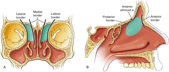 Fig. 9.6, Schematic drawings showing the boundaries of the frontal recess. (A) In the coronal plane, the medial boundary is the attachment of the middle turbinate. The lateral boundary is the orbit. (B) In the sagittal plane, the anterior border is the anterior wall of the agger nasi cell, which is continuous with the anterior buttress of the nasal spine, also called the nasal beak. The posterior-superior border is the attachment of the ethmoid bulla and/or the suprabullar cell.