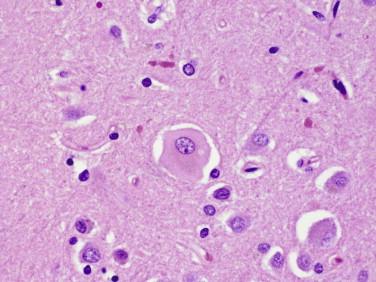 Fig 2, Corticobasal degeneration. Ballooned neurons show reduced cytoplasmic staining with loss of discernable Nissl substance (“achromasia”) and may contain vacuoles.