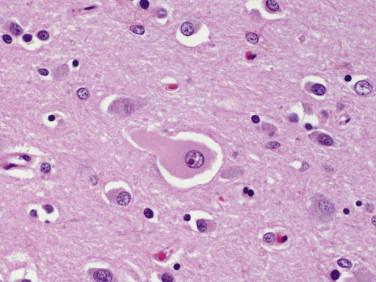 Fig 3, Corticobasal degeneration. A ballooned neuron demonstrates swelling of proximal a proximal dendrite.