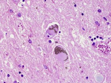 Fig 5, Corticobasal degeneration. Neurons of the substantia nigra may show displacement of normal neuromelanin pigment by abnormal cytoskeletal elements.