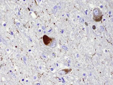 Fig 6, Corticobasal degeneration. An immunohistochemical study for tau shows strong cytoplasmic reactivity in a substantia nigra neuron.