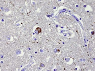 Fig 7, Corticobasal degeneration. Cortical neurons may contain irregular clumps or granular tau immunoreactivity.