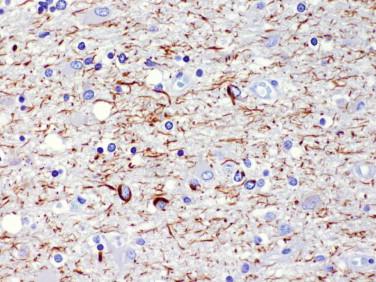 Fig 8, Corticobasal degeneration. A characteristic feature of the disease is the abundance of tau immunoreactivity of cell processes of the gray and white matter.