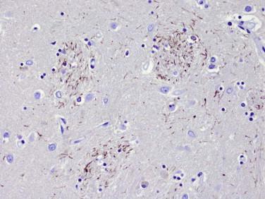 Fig 9, Corticobasal degeneration. The caudate nucleus and putamen characteristically contain many tau-positive fiber bundles like the “pencil fibers” shown in the image.