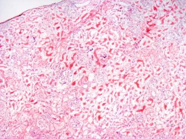 Figure 19-1, Artifactual separation of renal tubules on frozen section preparation. A low-power photomicrograph of renal cortex shows tubules that appear retracted and separated by clear spaces. This artifact can be misinterpreted as tubular atrophy, tubular injury/necrosis, or interstitial edema. This change is commonplace and may occur even in samples that are immediately prepared for frozen section. Permanent section of this kidney showed normal cortical architecture with back-to-back tubules (H&E, x4).