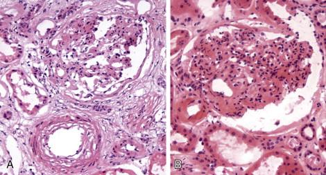 Figure 19-3, Moderate atherosclerosis. A, The artery branch shows thickening compatible with moderate arteriosclerosis. B, The arteriole at the base of the glomerulus shows hyaline thickening that would qualify as moderate arteriolosclerosis (H&E, x20).