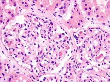 Figure 19-4, Glomerular thrombosis. Both glomeruli contain multiple capillary thromboses. These are characterized by pink deposits that can have a variable granular or fibrillary texture, may contain entrapped red cells, and may expand the capillary loops or have irregular shapes if cut longitudinally (H&E, x40).