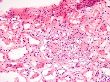 Figure 19-5, Diabetic glomerulopathy. The single glomerulus in the center of the image contains several nodular mesangial expansions that would qualify as Kimmelstiel-Wilson nodules. The remaining mesangial areas show more subtle expansion that can be detected by careful examination of frozen section (H&E, x40).