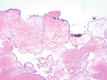 Figure 17-1, Ovarian tumor with involvement by serous borderline tumor (surface inked black prior to sectioning).
