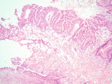 Figure 17-11, Same cyst as Figure 17-10 with areas of transition from benign mucinous cyst to borderline mucinous tumor with higher atypia (left).