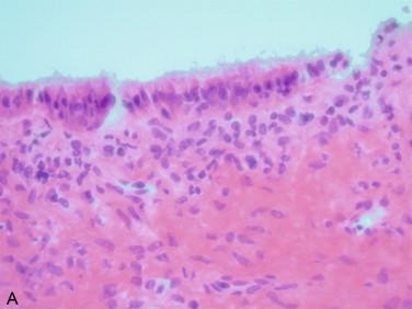 Figure 17-3, A and B, Cyst lined by single layer of mucinous epithelium. Note the presence of intracytoplasmic mucin.