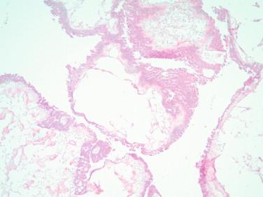 Figure 17-8, High-grade serous carcinoma with low-power mimicking serous borderline tumor.