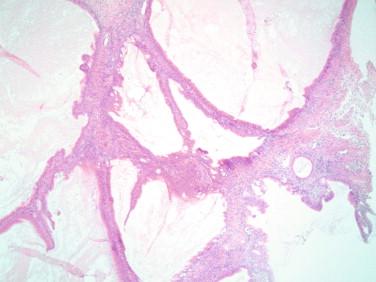 Figure 17-10, Multicystic ovarian lesion lined by mucinous epithelium. The complexity should raise concern for a borderline lesion.