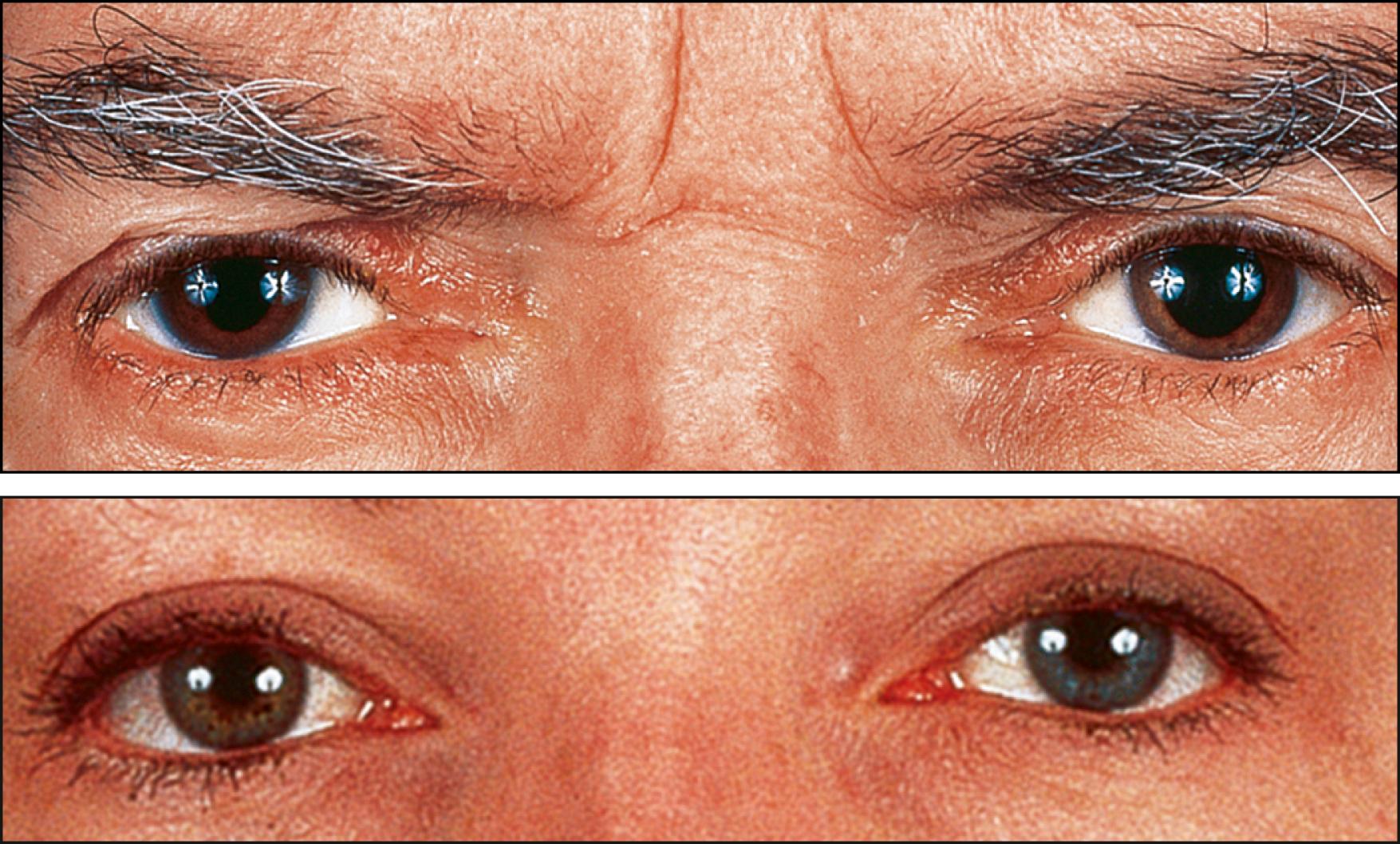 Fig. 107.1, Top , Heterochromic iridocyclitis in a brown-eyed patient. The left eye is involved, with lighter iris color. Bottom , Heterochromic iridocyclitis in a blue-eyed patient. The right eye is involved, with darker iris color.