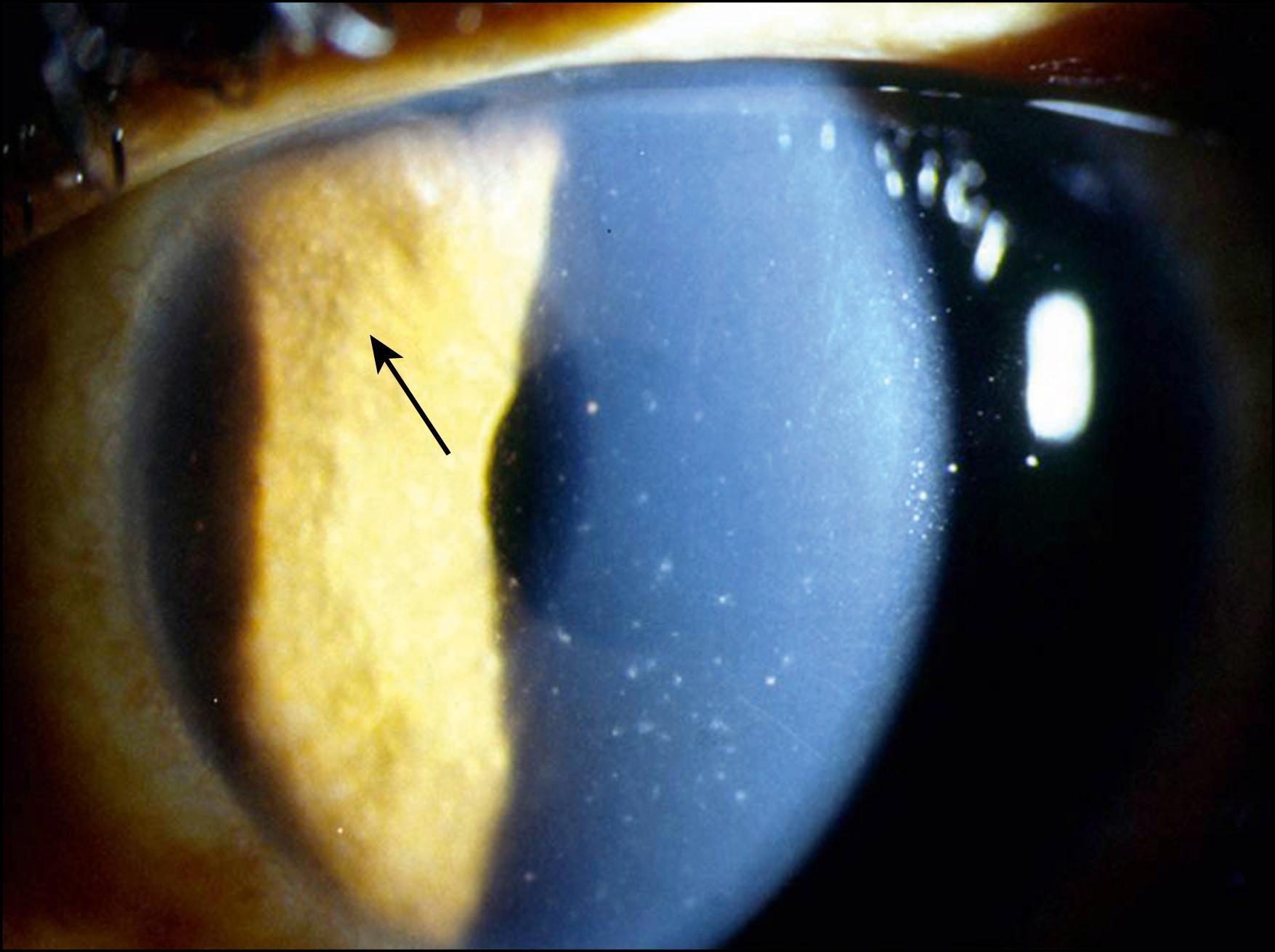 Fig. 107.2, Fine stellate keratic precipitates are seen throughout the cornea in this patient with FUS. Also note the small iris nodules (black arrow) that are commonly seen in dark-eyed patients with FUS.