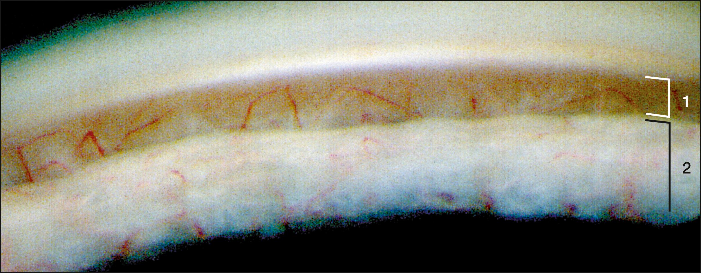 Fig. 107.4, Fine blood vessels course over the trabecular meshwork (1) and iris (2) in an eye with Fuchs uveitis syndrome.