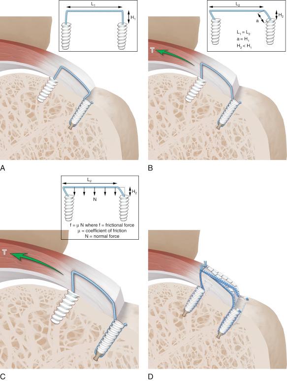 Fig. 7A.1, Schematic of the self-reinforcing suture bridge technique. A, Linked double-row construct before loading. Inset, Free body diagram of the construct. H1, Thickness of rotator cuff before loading; L1, length of tendon beneath suture. B, Loading of the linked double-row construct results in compression of rotator cuff footprint. Inset, Free body diagram of the construct. a, Length of suture between tendon edge and lateral anchor; H2, thickness of compressed rotator cuff under tensile load; L2, length of tendon beneath suture; T, tensile loading force. C, Up-close view of the linked double-row construct after loading. Inset, Free body diagram showing distributed normal force (N) resulting from elastic deformation of tendon beneath the suture. The frictional force (f) increases as the normal force (N) increases under load. D, Linked double-row construct with two medial anchors linked to two lateral anchors provides maximal footprint compression under loading. Additionally, a medial double-mattress stitch in this case provides a seal to joint fluid.
