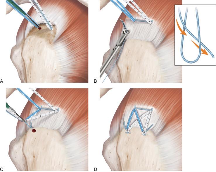 Fig. 7A.2, Schematic of a SpeedBridge (Arthrex, Naples, FL) rotator cuff repair with medial double-pulley and dog-ear reduction. A, Two medial anchors are placed for a SpeedBridge repair B, Medial sutures are passed through the rotator cuff in a single pass using a FiberLink (Arthrex). Then a mattress stitch is tied between the two anchors using the #2 FiberWire Eyelet safety stitches with a double-pulley technique. The FiberLink can then be used for dog-ear reduction. The closed end of the FiberLink is passed through the rotator cuff at the margin of the tear and is retrieved out the same portal as used for insertion. Inset, Extracorporeally, the closed end of the FiberLink is passed through the looped end to create a cinch loop. C, The cinch loop, a suture from the anteromedial anchor, and a suture from the posteromedial anchor are secured laterally with a BioComposite SwivelLock C anchor. D, Final appearance after placement of a posterior FiberLink and a posterolateral anchor.