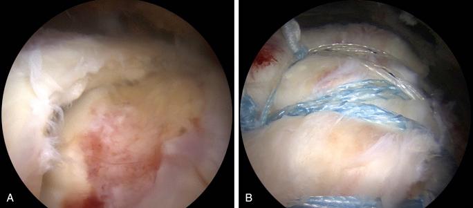 Fig. 7A.3, A, Right shoulder, posterior subacromial viewing portal demonstrating a crescent-type full-thickness posterosuperior rotator cuff tear. B, Right shoulder, posterior subacromial viewing portal demonstrating SpeedBridge (Arthrex, Naples, FL) rotator cuff repair with medial double-pulley and dog-ear reduction.