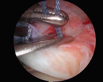 FIGURE 12.13, Retrieval of suture from the anterior portal.