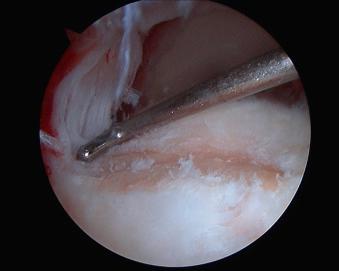 FIGURE 12.27, Measure the rotator cuff tear.