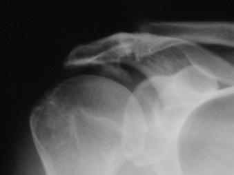 FIGURE 12.3, Ossification of the coracoacromial ligament.