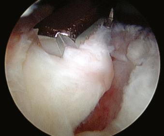 FIGURE 12.39, Insert the grasper through the anterior cannula to test tendon mobility.
