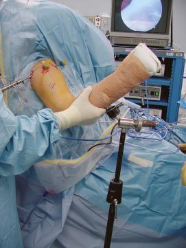 FIGURE 12.41, Abduct and externally rotate the arm until the tear is reduced and directly under the lateral cannula.
