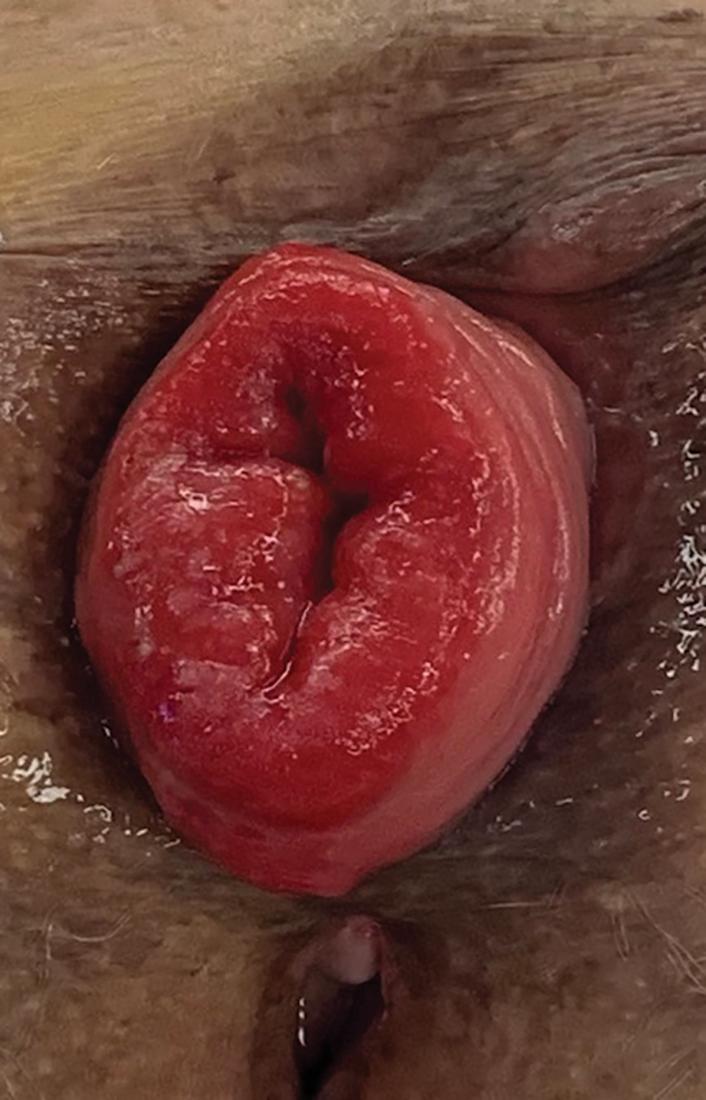 Fig. 30.1, Full-thickness rectal prolapse showing concentric folds of rectal mucosa indicating full–thickness protrusion of the rectum.