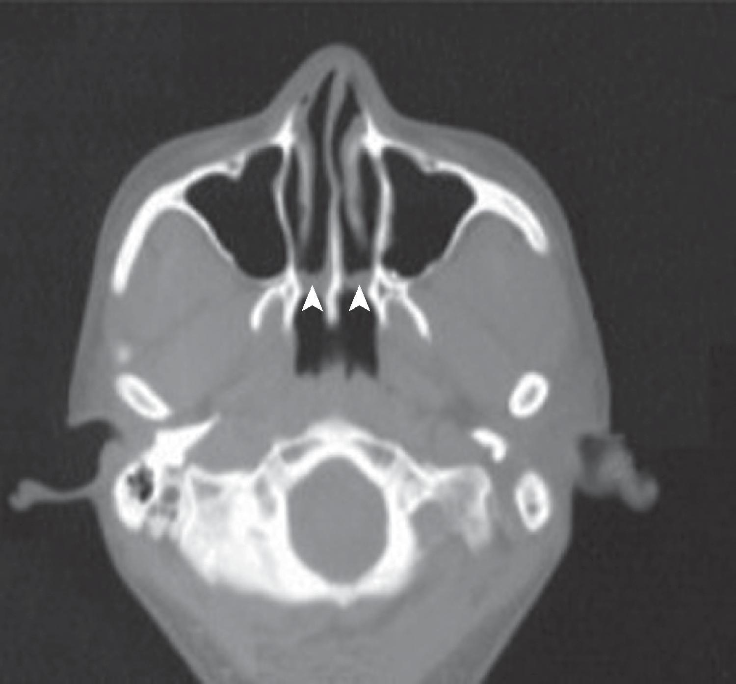 Fig. 1.2, Bilateral choanal atresia as seen by computed tomography. Arrows point to the area of posterior obstruction.