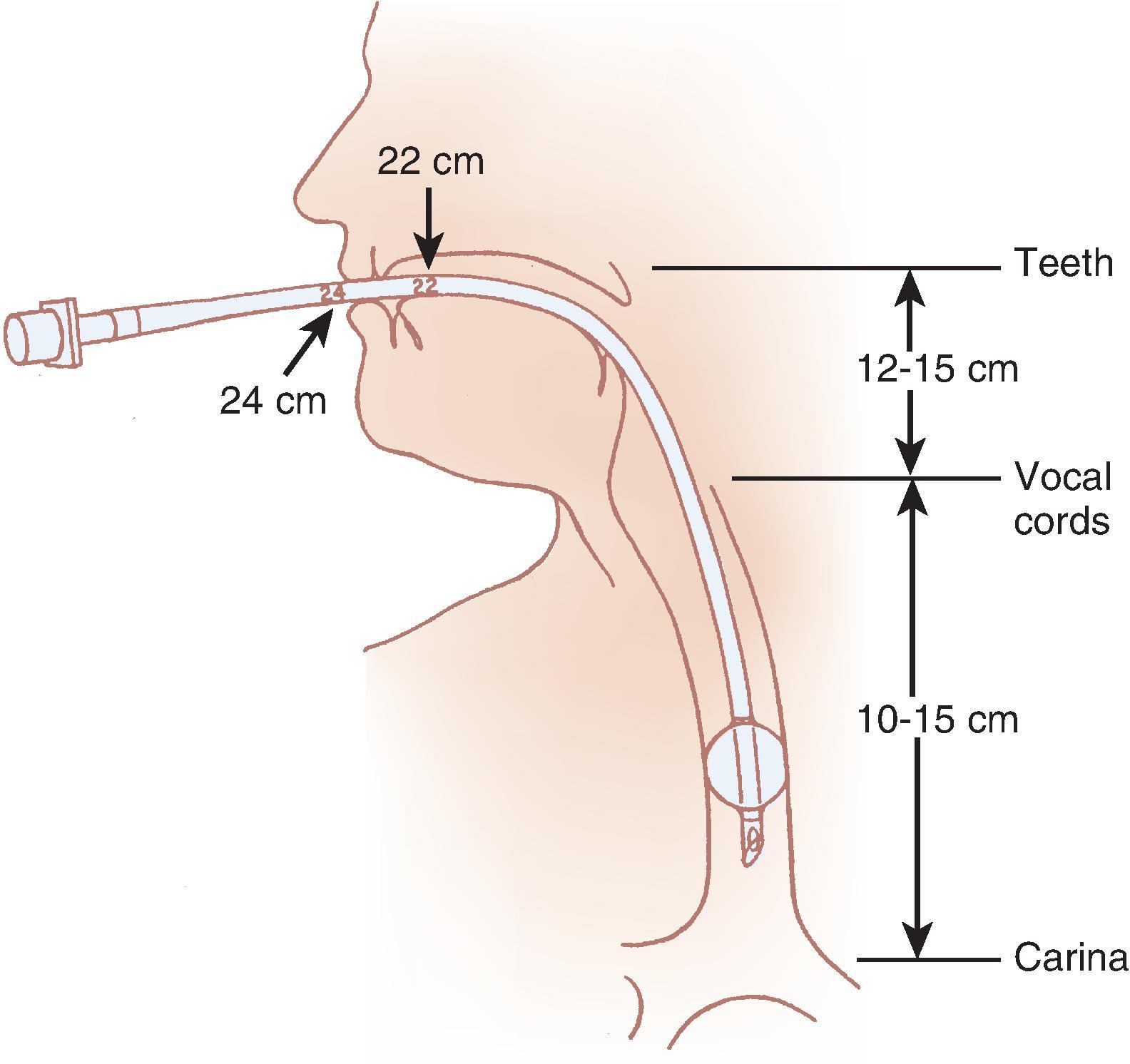 Fig. 1.4, Important distances for proper endotracheal tube placement.