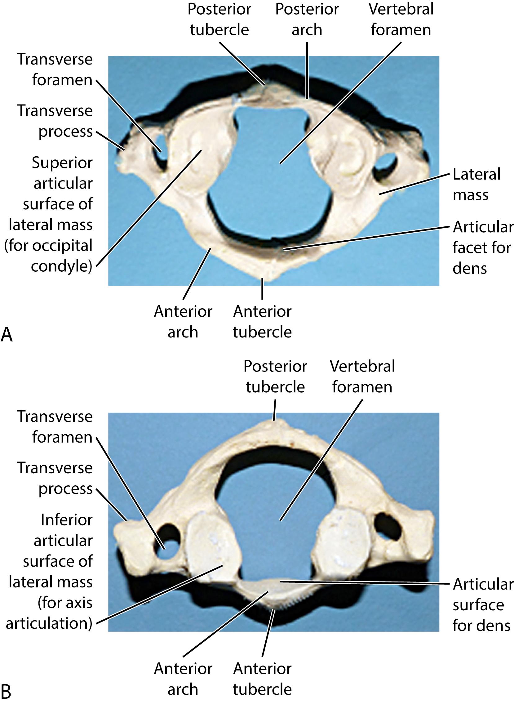 Fig. 4.7, The anatomy of the atlas (C1) demonstrating its unique osseous anatomy with noted lack of an anterior body and large lateral masses. Superior (A) and inferior (B) views.