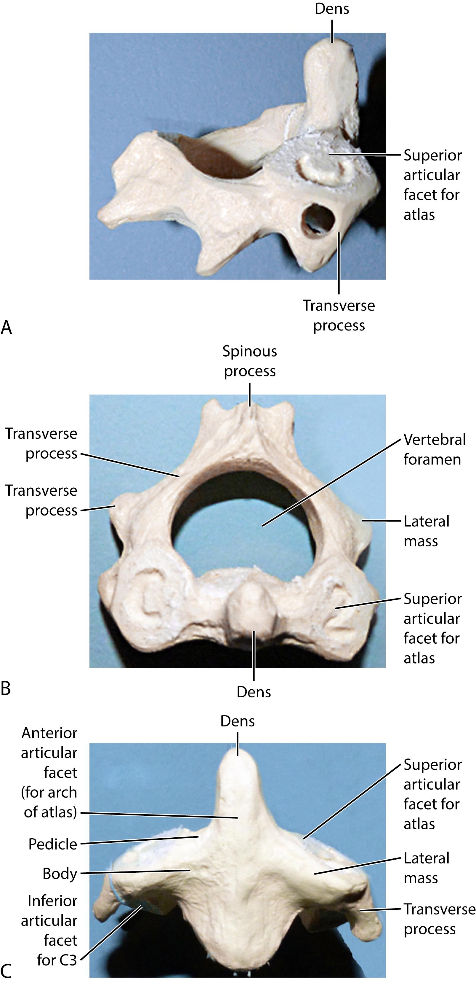 Fig. 4.8, The anatomy of the axis (C2) demonstrating its unique osseous anatomy with its large anterior dens that allows for 50% of the cervical spine’s rotation through its articulation with the atlas. Lateral (A) , superior (B) , and anterior (C) views.