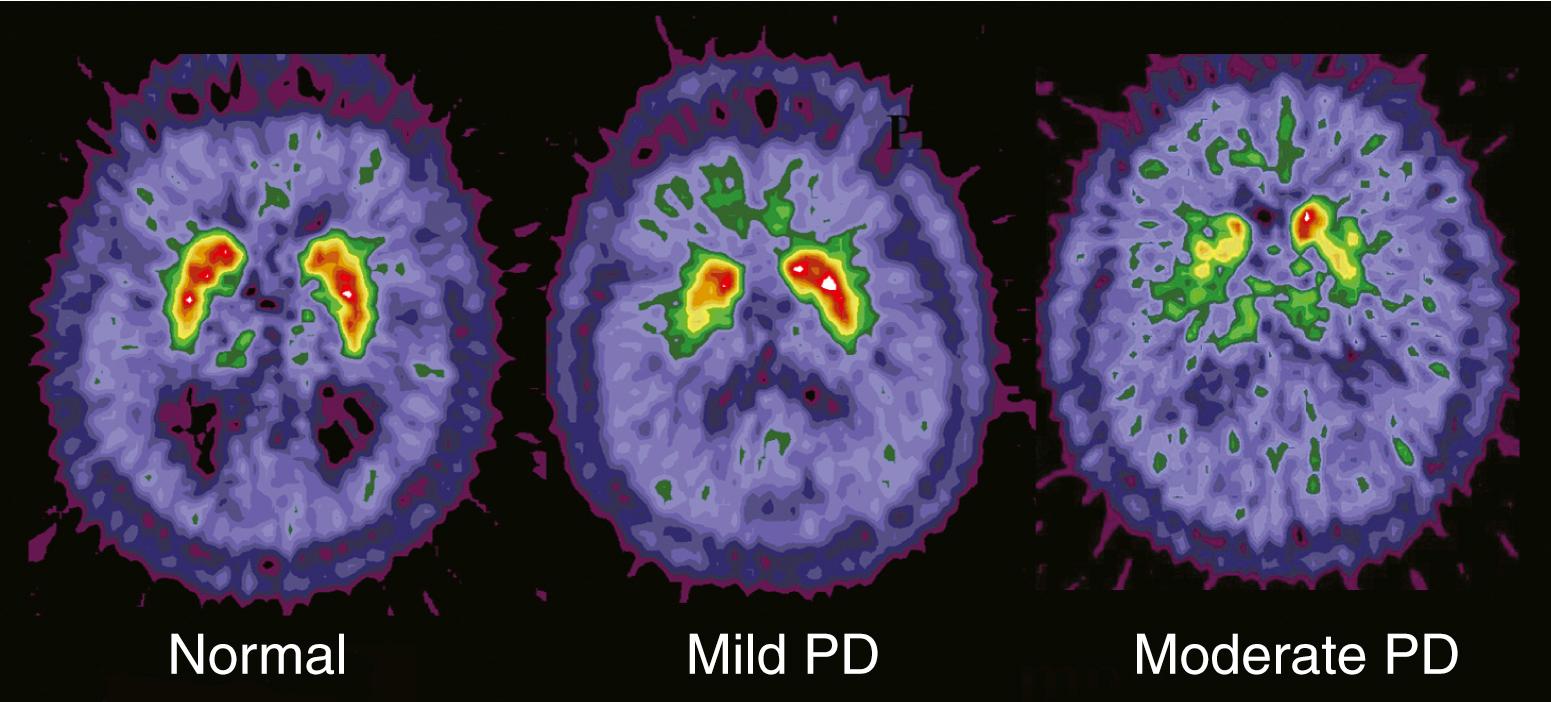 Figure 107.2, Positron emission tomography (PET) images of striatal fluoride 18 ( 18 F)–fluorodopa uptake in a normal control subject, an individual with mild Parkinson disease (PD), and an individual with moderate PD.