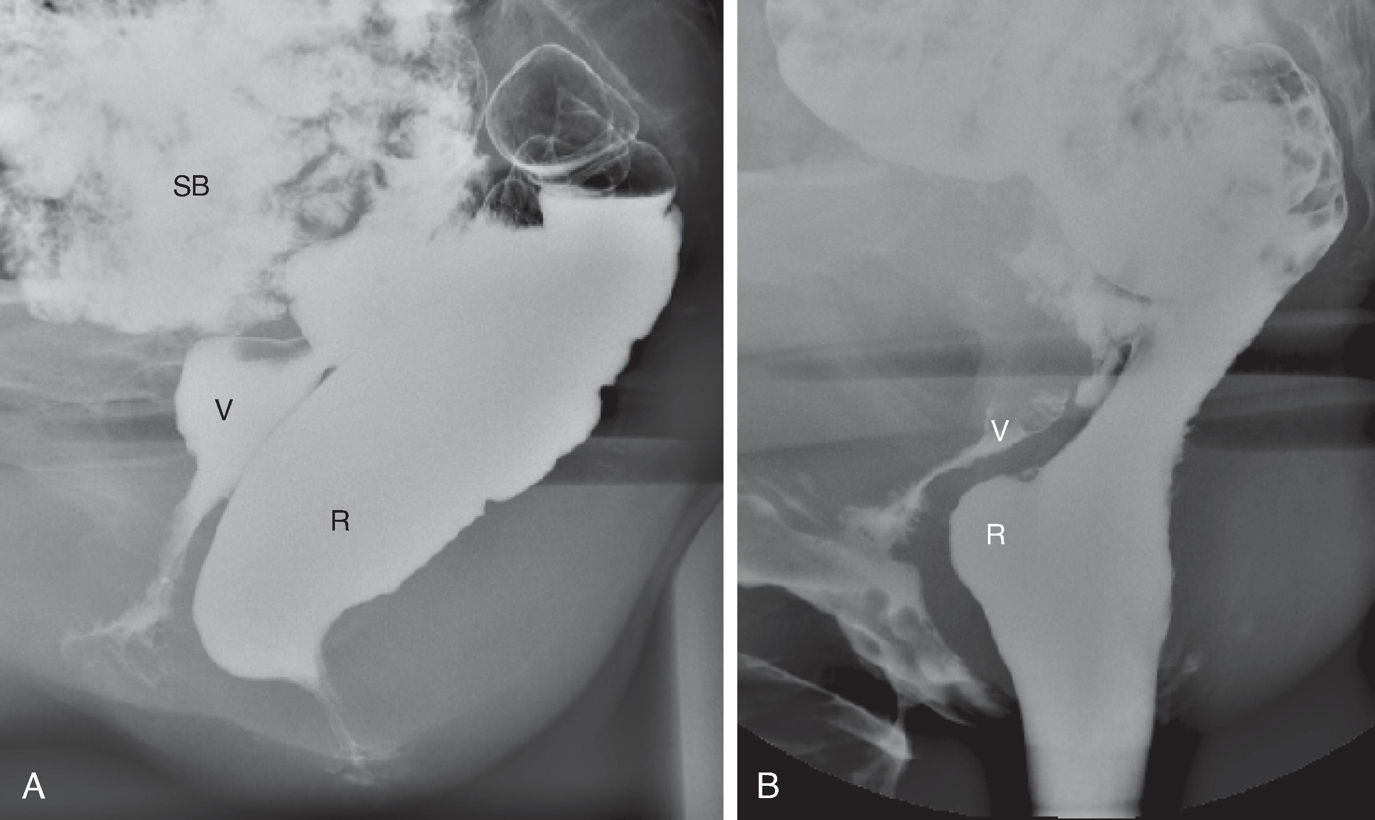 Fig. 37.2, Normal rectum.