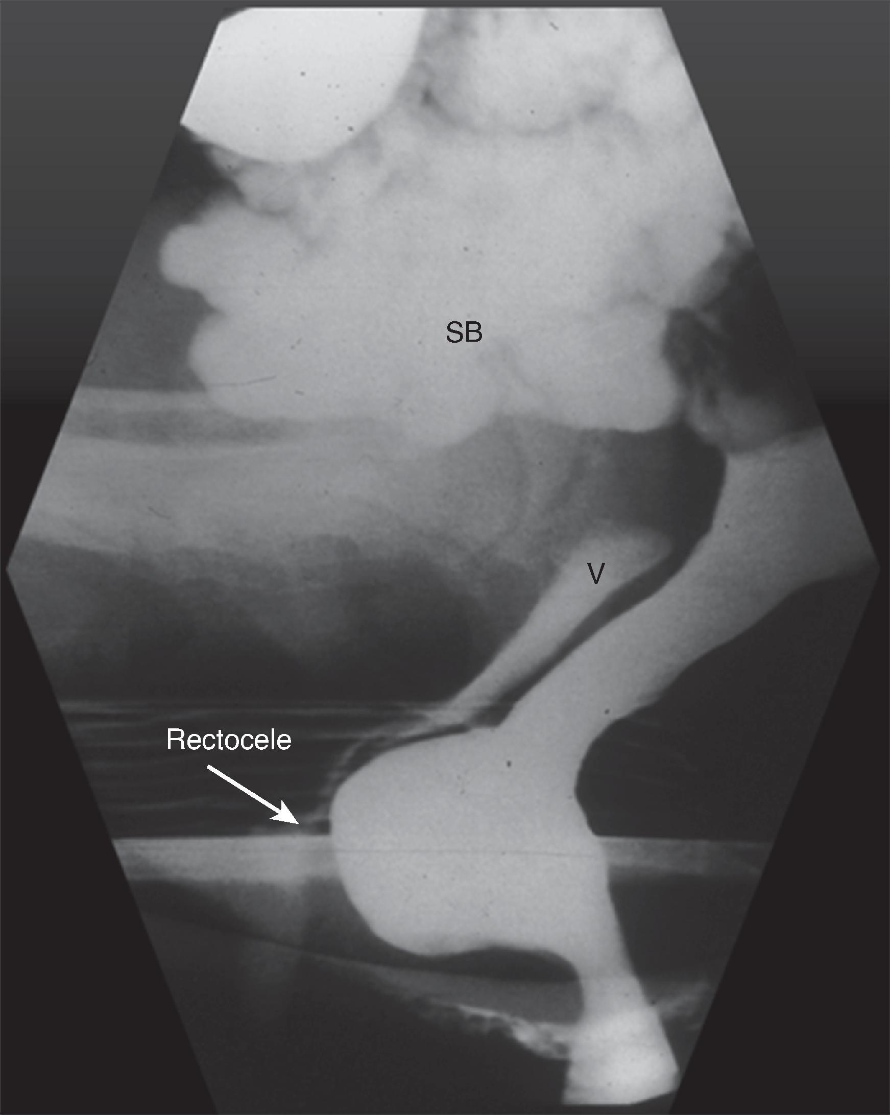 Fig. 37.4, Rectocele.