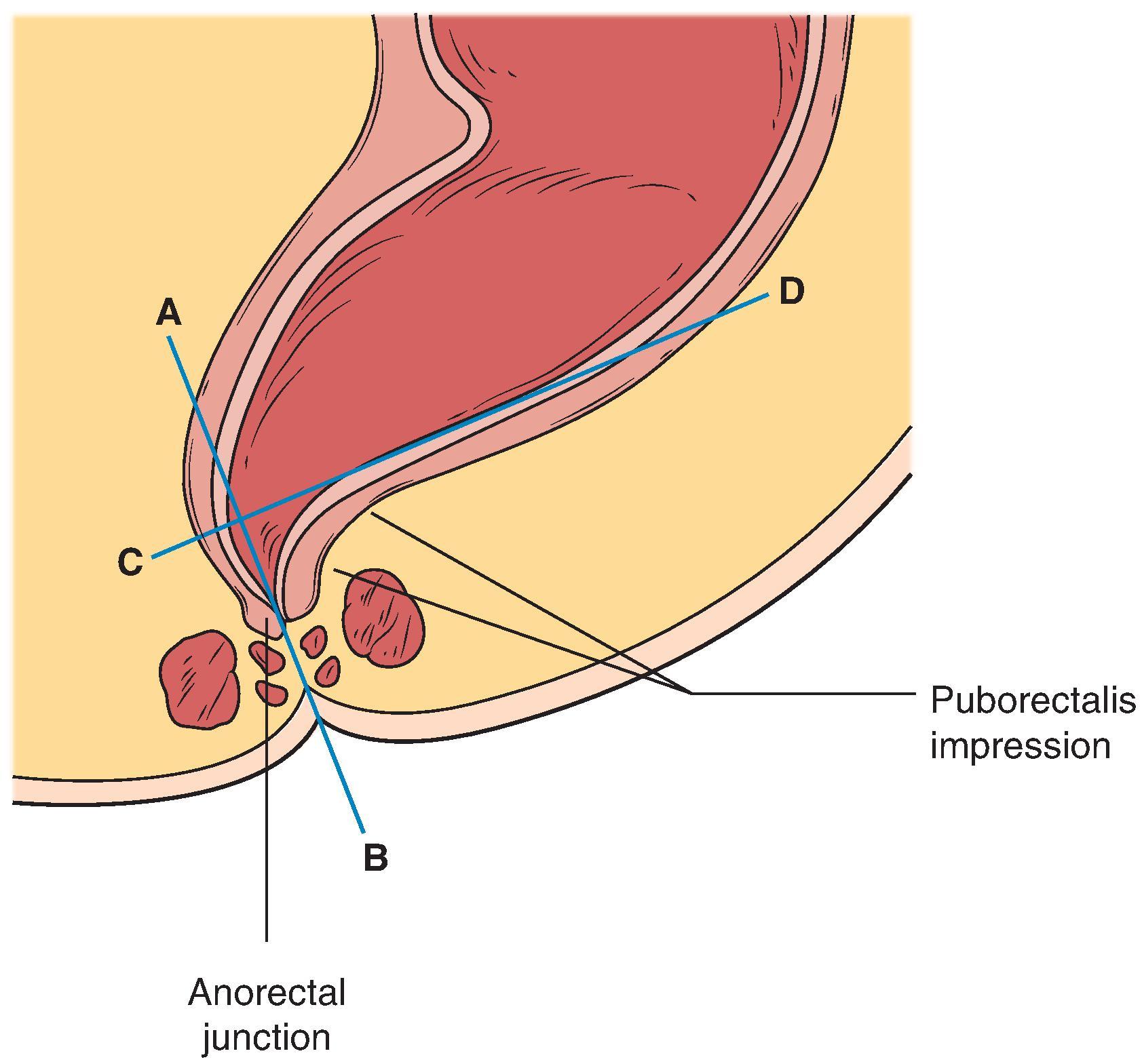 Fig. 37.5, Schematic showing the anorectal angle.