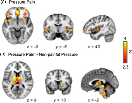 Figure 46.1, Brain regions involved in (A) pressure pain processes and (B) pressure pain > nonpainful pressure as measured by BOLD fMRI from simultaneous PET/MRI scans. BOLD , blood oxygenation level dependent; PET , positron emission tomography; MRI , magnetic resonance imaging.