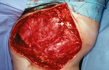 Figure 23.11, Intraoperative view showing a very stable, fascia-like layer after deep dermabrasion of the skin graft. Note the contralateral lower intercostal nerve dissected (arrow).