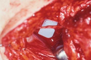 Figure 23.12, Nerve coaptation of the thoracodorsal nerve of the free latissimus flap to a lower branch of the intercostal nerves supplying the rectus abdominis muscle.