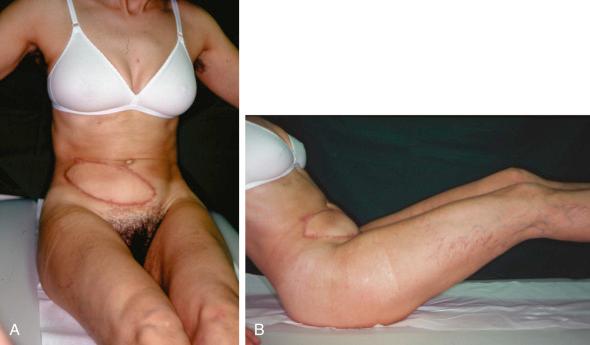 Figure 23.13, Patient is shown 23 months after reconstruction with innervated latissimus dorsi flap in (A) anterior and (B) lateral view. Note synergistic function of the transferred latissimus dorsi and rectus muscles with near perfect symmetry and contour without bulging.