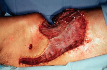 Figure 23.14, Intraoperative view after tissue debridement and primary coverage with meshed skin grafts.