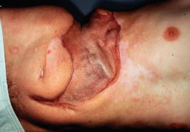 Figure 23.15, A 1-year postoperative view showing meshed skin graft firmly adherent to bowel.