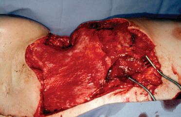 Figure 23.16, Intraoperative view after deep dermabrasion of meshed skin showing a stable dermal layer.