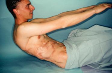 Figure 23.19, Functional result 3-year postoperative with patient performing sit-up. Note synergistic function of the transferred latissimus dorsi and rectus muscles with near perfect symmetry and contour without bulging.
