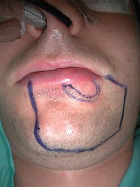 Figure 23.2, Preoperative view of a 21-year-old man affected by a sclerosing basosquamous cancer of the left lower lip. The extension of the resection requested by the oncologist, after tumor biopsy, is marked.