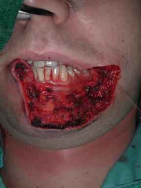 Figure 23.3, Intraoperative view after subtotal full-thickness lower lip resection.