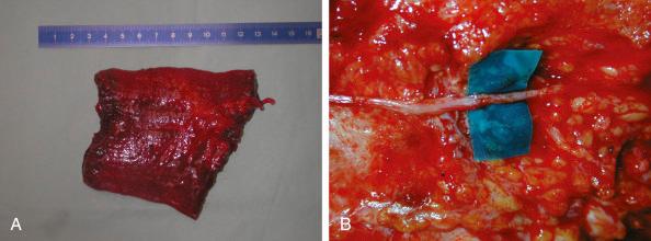 Figure 23.5, The gracilis muscle free flap (9 × 6 cm). (A) Harvested, (B) following nerve coaptation.